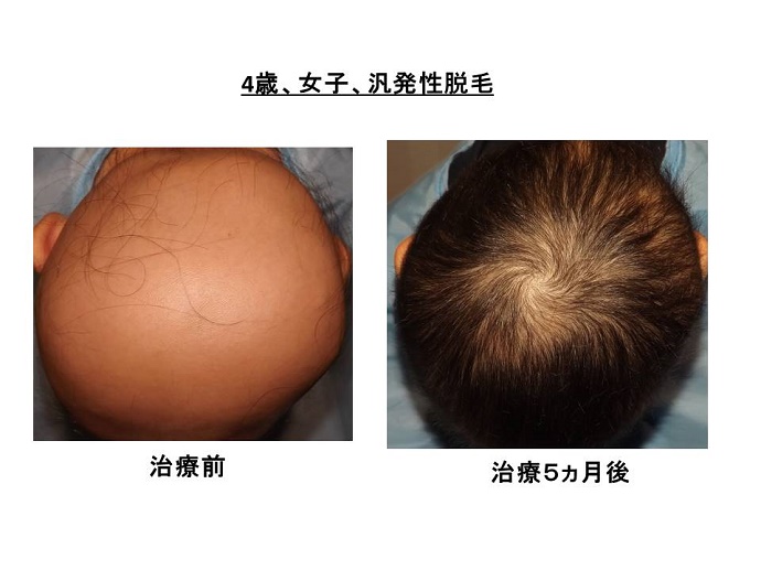 円形脱毛症　病院""